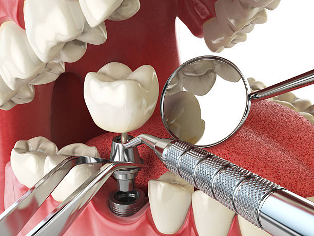Best Emergency Treatment for Dental Infections or Abscesses in St Augustine, FL